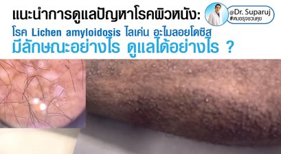 แนะนำการดูแลปัญหาโรคผิวหนัง: โรค Lichen amyloidosis ไลเค่น อะไมลอยโดซิส มีลักษณะอย่างไร ดูแลได้อย่างไร ?